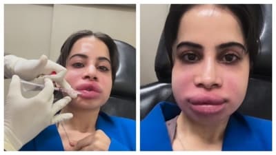 Uorfi Javed shared glimpses of the session where she dissolved her lip fillers. (PC: IG/@urf7i) Uorfi Javed shared glimpses of the session where she dissolved her lip fillers. (PC: IG/@urf7i)