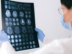 Glioblastoma can affect people below the age of 40. Glioblastoma can affect people below the age of 40.