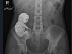 An ER doctor shared an X-ray showing a rare 'stone baby' case.
