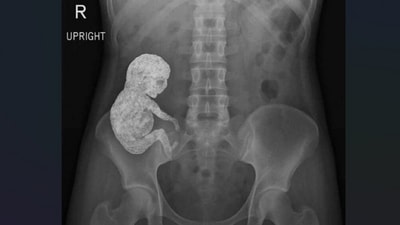 An ER doctor shared an X-ray showing a rare 'stone baby' case. (X/@EM_RESUS)
