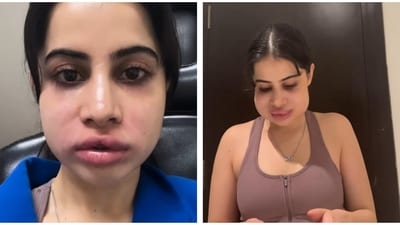 Uorfi Javed shared a new video of her swollen face on Instagram. Uorfi Javed shared a new video of her swollen face on Instagram.