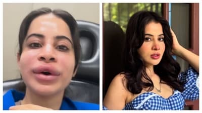 Uorfi Javed's face and lips became swollen (left) after the lip filler dissolving procedure for the initial days, but her latest picture (right) shows her new lips back to normal. (PC: IG/@urf7i) Uorfi Javed's face and lips became swollen (left) after the lip filler dissolving procedure for the initial days, but her latest picture (right) shows her new lips back to normal. (PC: IG/@urf7i)