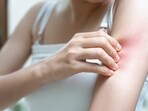In the monsoon, rashes are common. In the monsoon, rashes are common.