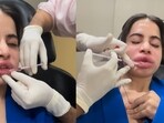 Uorfi Javed’s lip filler reversal: Experts weigh in(Photos: Instagram / urf7i)