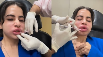 Uorfi Javed’s lip filler reversal: Experts weigh in (Photos: Instagram / urf7i) Uorfi Javed’s lip filler reversal: Experts weigh in (Photos: Instagram / urf7i)