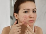 Acne may look alike, but may have different root causes. Acne may look alike, but may have different root causes.