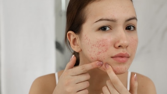 Acne may look alike, but may have different root causes. (Shutterstock)