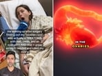 Dr Kunal Sood explained teratomas, a type of tumour, as he reacted to a video of a woman narrating her experience. (Instagram/ doctorsoood) Dr Kunal Sood explained teratomas, a type of tumour, as he reacted to a video of a woman narrating her experience. (Instagram/ doctorsoood)