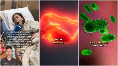 Dr Kunal Sood explained teratomas, a type of tumour, as he reacted to a video of a woman narrating her experience. (Instagram/ doctorsoood) Dr Kunal Sood explained teratomas, a type of tumour, as he reacted to a video of a woman narrating her experience. (Instagram/ doctorsoood)