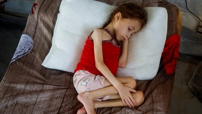 Jana Ayad, a little girl from Palestine lying on a hospital bed in International Medical Corps field hospital as she receives treatment for malnutrition. (Mohammed Salem/REUTERS)