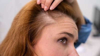 Alopecia can point to underlying health conditions, lifestyle factors, or genetic predispositions. (Freepik) Alopecia can point to underlying health conditions, lifestyle factors, or genetic predispositions. (Freepik)