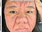 A Malaysian woman has shared how pregnancy impacted her face. Pics: TikTok/@ayyitslala