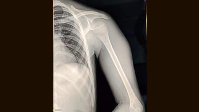 Police are verifying the family’s claim of a fracture. Prima facie, the widely circulated video and X-ray report suggest a dislocation of the shoulder rather than a fracture, officers said. (HT Photos) Police are verifying the family’s claim of a fracture. Prima facie, the widely circulated video and X-ray report suggest a dislocation of the shoulder rather than a fracture, officers said. (HT Photos)