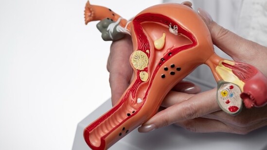 The first signs of uterine fibroids can be confused for an entirely less serious problem since they can appear suddenly. (Freepik)