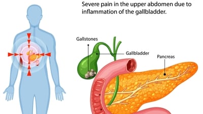 A gallbladder attack, also known as biliary colic or a gallstone attack, is a sudden and severe pain caused by a gallstone blocking the bile ducts. (Freepik) A gallbladder attack, also known as biliary colic or a gallstone attack, is a sudden and severe pain caused by a gallstone blocking the bile ducts. (Freepik)