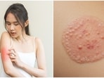 Dr Dhekne stressed that maintaining public cleanliness helps stop the spread of scabies and ringworm. Dr Dhekne stressed that maintaining public cleanliness helps stop the spread of scabies and ringworm.
