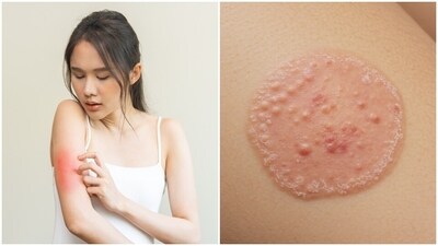 Dr Dhekne stressed that maintaining public cleanliness helps stop the spread of scabies and ringworm. (Shutterstock) Dr Dhekne stressed that maintaining public cleanliness helps stop the spread of scabies and ringworm. (Shutterstock)