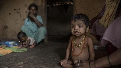 Mumbai, India - September 17, 2016: Three-year-old Manoj Pawar is suffering from malnutrition at Bambi Pada, Jawahar, Palghar District, India, on Saturday, September 17, 2016. (Photo by Satish Bate/ Hindustan Times) (Satish Bate/HT PHOTO) Mumbai, India - September 17, 2016: Three-year-old Manoj Pawar is suffering from malnutrition at Bambi Pada, Jawahar, Palghar District, India, on Saturday, September 17, 2016. (Photo by Satish Bate/ Hindustan Times) (Satish Bate/HT PHOTO)
