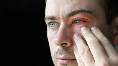 Eyes turned red and inflamed because of conjunctivitis. (Shutterstock) Eyes turned red and inflamed because of conjunctivitis. (Shutterstock)