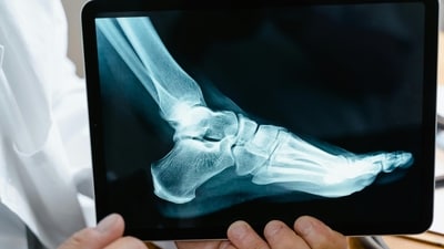 Physical exercise, nutrition and lifestyle choices affect bone health. (Pexel) Physical exercise, nutrition and lifestyle choices affect bone health. (Pexel)