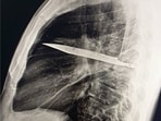 As per the medical report, a right thoracotomy was performed, and the foreign body was successfully removed. The patient had an uncomplicated postoperative recovery. (Pic courtesy: National Library of Medicine) As per the medical report, a right thoracotomy was performed, and the foreign body was successfully removed. The patient had an uncomplicated postoperative recovery. (Pic courtesy: National Library of Medicine)