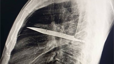 As per the medical report, a right thoracotomy was performed, and the foreign body was successfully removed. The patient had an uncomplicated postoperative recovery. (Pic courtesy: National Library of Medicine) As per the medical report, a right thoracotomy was performed, and the foreign body was successfully removed. The patient had an uncomplicated postoperative recovery. (Pic courtesy: National Library of Medicine)
