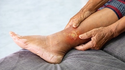 Leg gangrene's risks increase in monsoon. (Shutterstock) Leg gangrene's risks increase in monsoon. (Shutterstock)