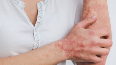 Monsoon can make psoriasis conditions worsen. (Image by Eszter Miller from Pixabay ) Monsoon can make psoriasis conditions worsen. (Image by Eszter Miller from Pixabay )