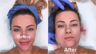 Woman reflects on social media's influence on beauty standards after cosmetic surgery misstep. (Instagram/@aspenbrookpotter) Woman reflects on social media's influence on beauty standards after cosmetic surgery misstep. (Instagram/@aspenbrookpotter)