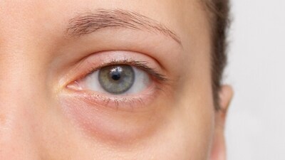 Puffy eyes are an indication of poor lymphatic drainage. (Shutterstock) Puffy eyes are an indication of poor lymphatic drainage. (Shutterstock)
