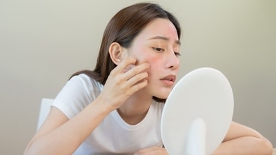 People with acne-prone skin suffer more this monsoon from flare-ups. (Shutterstock) People with acne-prone skin suffer more this monsoon from flare-ups. (Shutterstock)