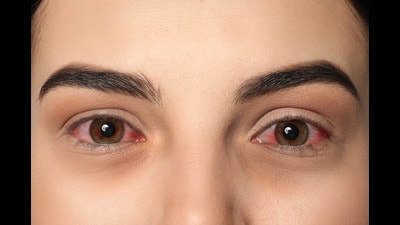 Common symptoms include itchiness, swelling, sticky discharge, excessive tearing, and sensitivity to light (photophobia). It may be caused by viral or bacterial infection—both of which are highly contagious—or by allergies, which are not contagious. (REPRESENTATIVE PIC) Common symptoms include itchiness, swelling, sticky discharge, excessive tearing, and sensitivity to light (photophobia). It may be caused by viral or bacterial infection—both of which are highly contagious—or by allergies, which are not contagious. (REPRESENTATIVE PIC)
