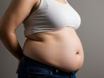 Severe obesity needs medical intervention. Severe obesity needs medical intervention.