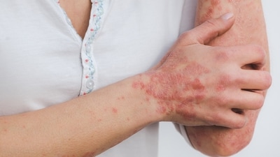 Alcohol and poor diet linked to increased psoriasis flare-ups, experts warn. (Image by Eszter Miller from Pixabay ) Alcohol and poor diet linked to increased psoriasis flare-ups, experts warn. (Image by Eszter Miller from Pixabay )