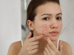To prevent acnes, the dermatologist suggested using a separate towel for your face and body. To prevent acnes, the dermatologist suggested using a separate towel for your face and body.