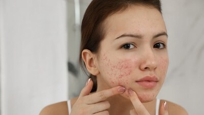 To prevent acnes, the dermatologist suggested using a separate towel for your face and body. (Shutterstock) To prevent acnes, the dermatologist suggested using a separate towel for your face and body. (Shutterstock)
