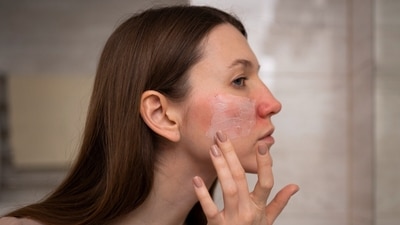 Fairness creams may initially seem effective but can lead to severe skin damage, including thinning skin, visible, redness and irritation, increased facial hair, dependency and addiction. (Freepik) Fairness creams may initially seem effective but can lead to severe skin damage, including thinning skin, visible, redness and irritation, increased facial hair, dependency and addiction. (Freepik)