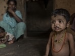 Three-year-old Manoj Pawar is suffering from malnutrition. (Photo by Satish Bate/ Hindustan Times) (Satish Bate/HT PHOTO)