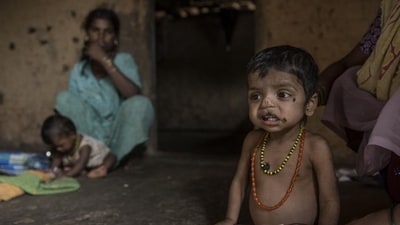 Three-year-old Manoj Pawar is suffering from malnutrition. (Photo by Satish Bate/ Hindustan Times) (Satish Bate/HT PHOTO) Three-year-old Manoj Pawar is suffering from malnutrition. (Photo by Satish Bate/ Hindustan Times) (Satish Bate/HT PHOTO)