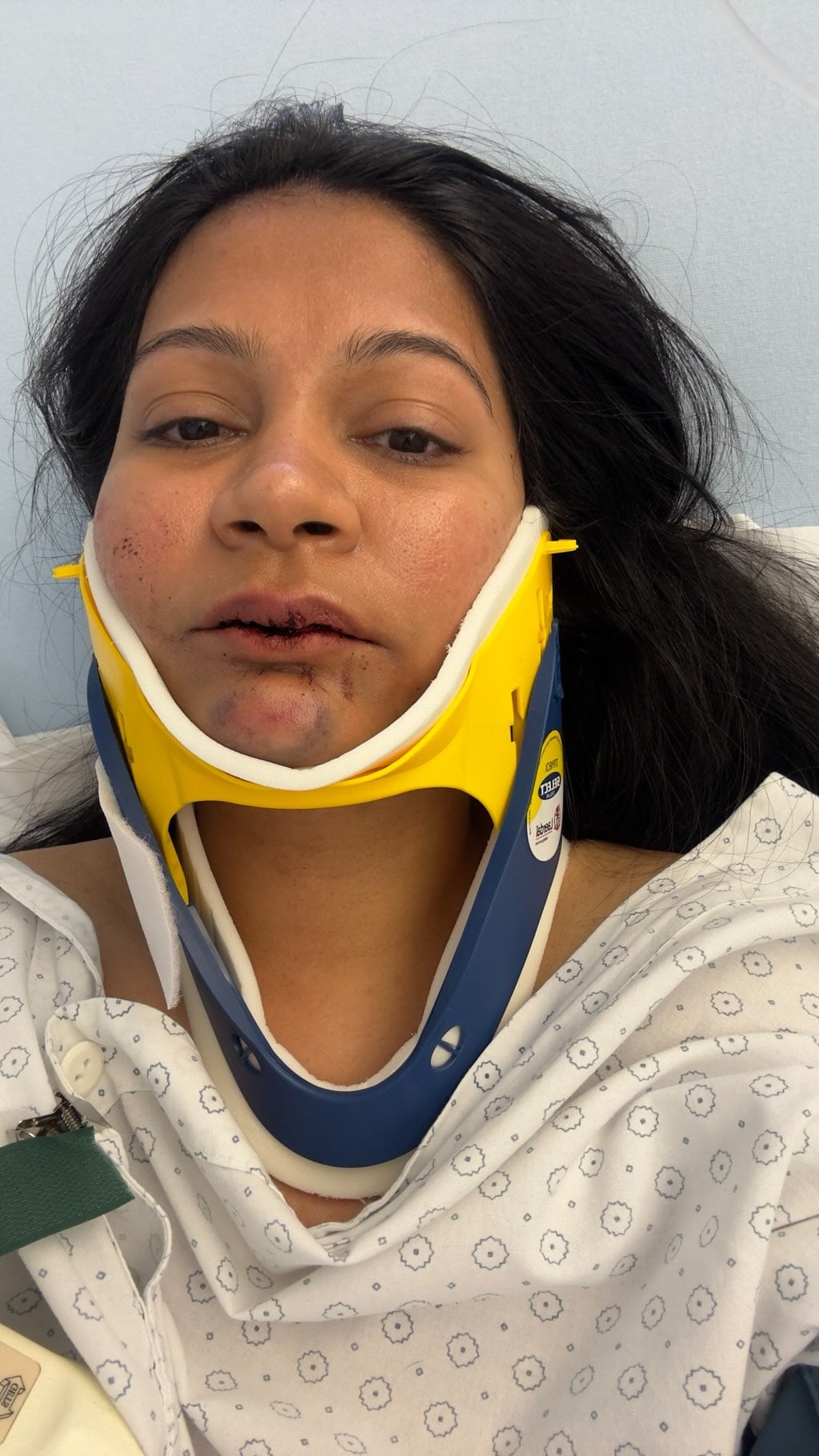 Nikita got medical treatment after an alleged attack by a Chinese man in Switzerland. (Nikita and Karan)
