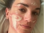 Victoria Nelson has detailed her experience with severe burns that she alleges are due to a chemical peel given by a Beverly Hills celebrity esthetician. (Instagram/ Victoria Nelson) Victoria Nelson has detailed her experience with severe burns that she alleges are due to a chemical peel given by a Beverly Hills celebrity esthetician. (Instagram/ Victoria Nelson)