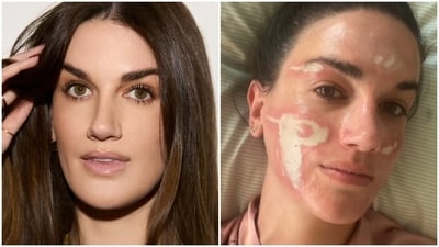 Victoria Nelson has detailed her experience with severe burns that she alleges are due to a chemical peel given by a Beverly Hills celebrity esthetician. (Instagram/ Victoria Nelson) Victoria Nelson has detailed her experience with severe burns that she alleges are due to a chemical peel given by a Beverly Hills celebrity esthetician. (Instagram/ Victoria Nelson)