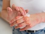 Eczema is a chronic skin condition. Eczema is a chronic skin condition.