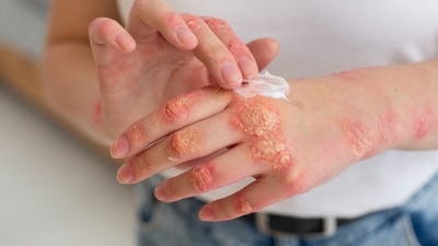 Eczema is a chronic skin condition. Eczema is a chronic skin condition.