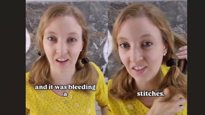 An American woman recounted how her thumb injury was treated in India for just ₹50. (Instagram/kristenfischer3) An American woman recounted how her thumb injury was treated in India for just ₹50. (Instagram/kristenfischer3)
