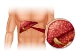 Approximately 10–20 percent of the national adult population currently carries gallstones. Approximately 10–20 percent of the national adult population currently carries gallstones.