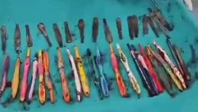 The man reportedly used to steal the spoons, take them to the bathroom, break them into pieces and push them down his throat. (Screengrab/X/@Indian__doctor) The man reportedly used to steal the spoons, take them to the bathroom, break them into pieces and push them down his throat. (Screengrab/X/@Indian__doctor)