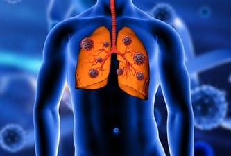Lung cancer doesn't always come with a warning. Get evaluated if you have ongoing symptoms. (Freepik) Lung cancer doesn't always come with a warning. Get evaluated if you have ongoing symptoms. (Freepik)