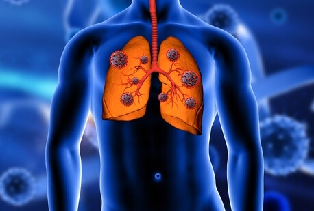 Lung cancer doesn't always come with a warning. Get evaluated if you have ongoing symptoms. (Freepik)