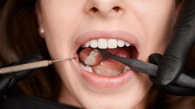 Cavities can be painful and inconvenient, requiring dental visits and potentially leading to more severe oral health issues if not addressed. (Freepik) Cavities can be painful and inconvenient, requiring dental visits and potentially leading to more severe oral health issues if not addressed. (Freepik)